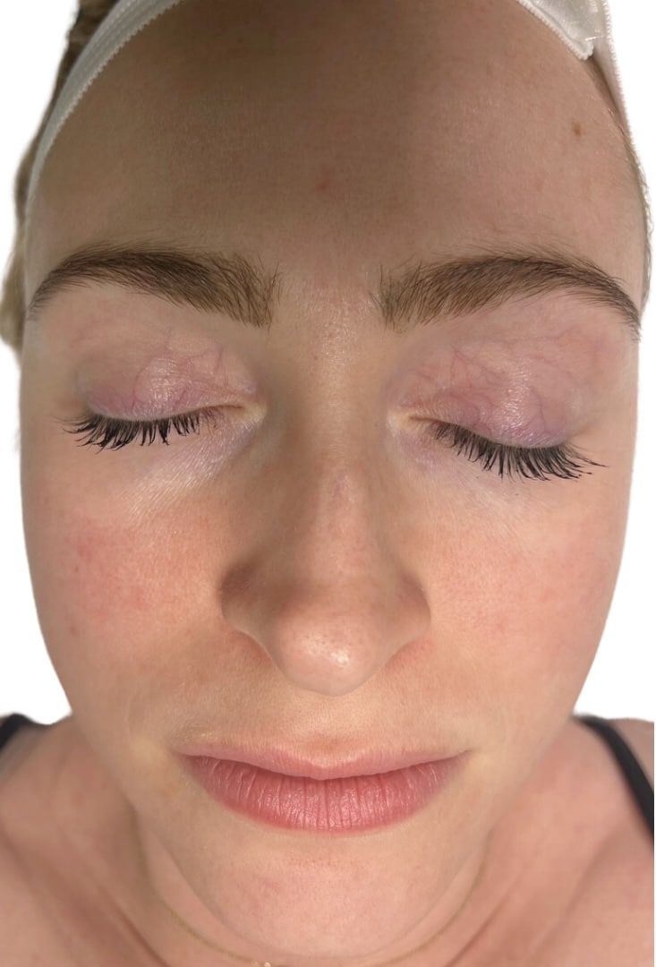 After Image: Acne Chemical Peel - front