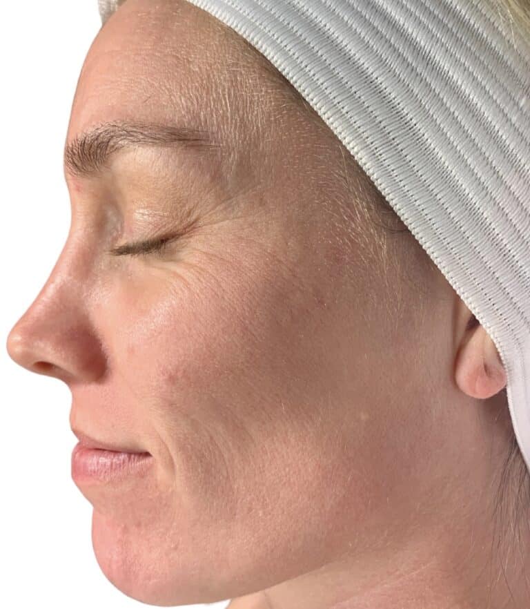 After Image: Acne Chemical Peel - other