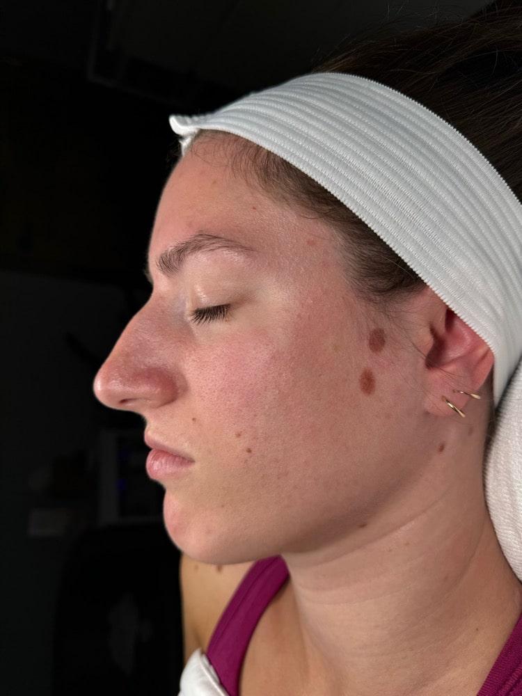 After Image: Chemical Peel - front