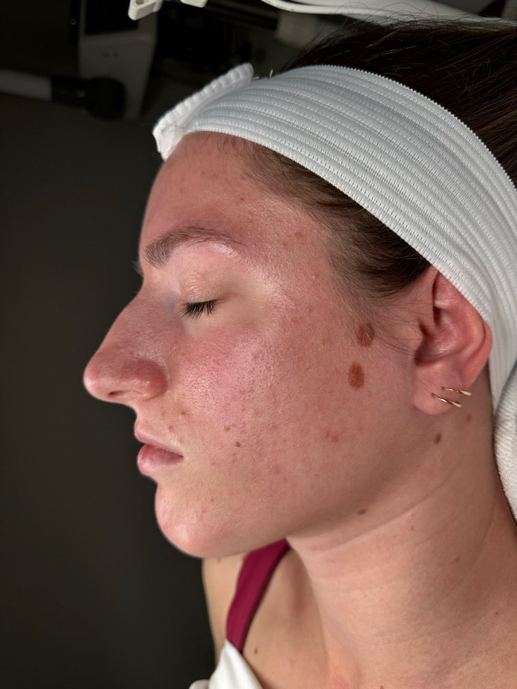 Before Image: Chemical Peel - front