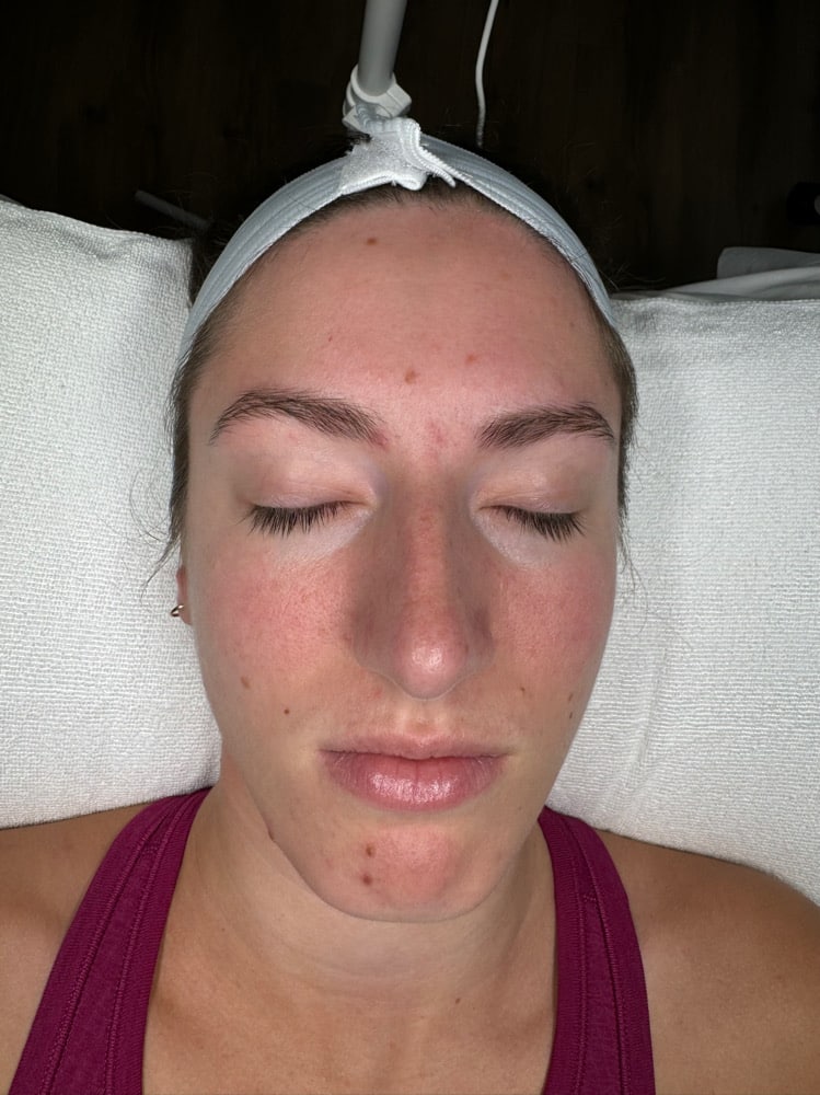 After Image: Chemical Peel -