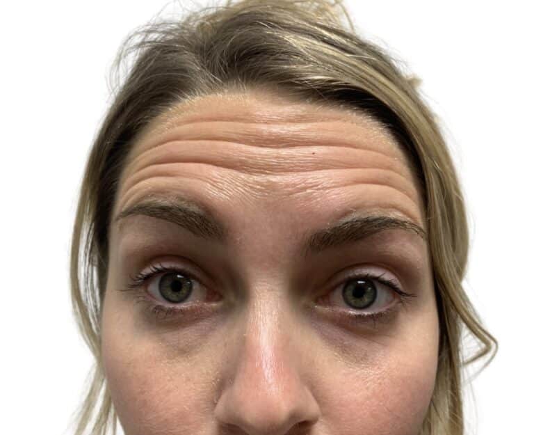 Before Image: Botox/Dysport - front