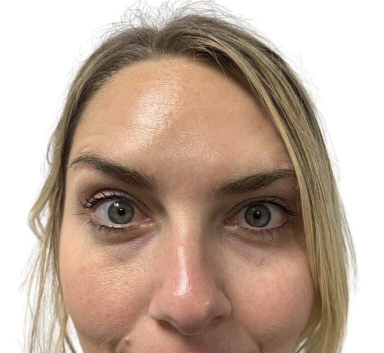 After Image: Botox/Dysport - front
