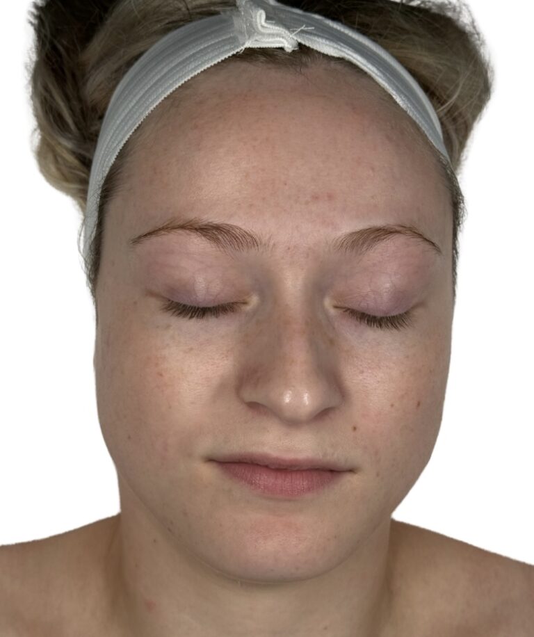 After Image: Acne Chemical Peel - front