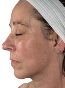 After Image: Microneedling