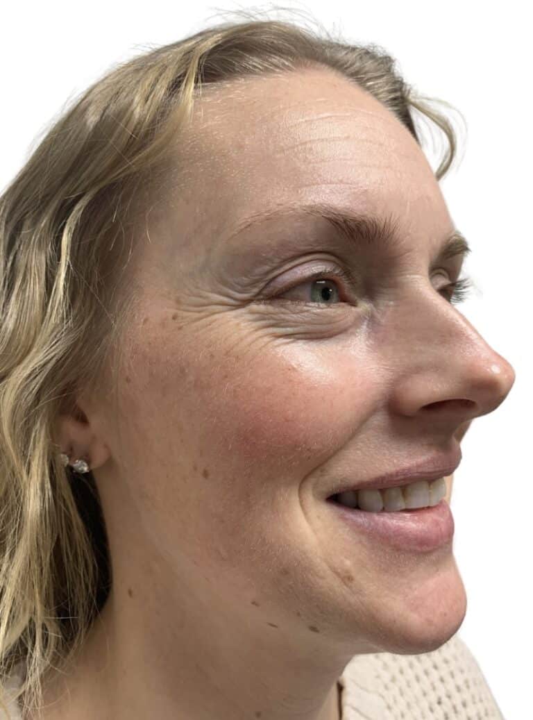 Before Image: Botox/Dysport - front
