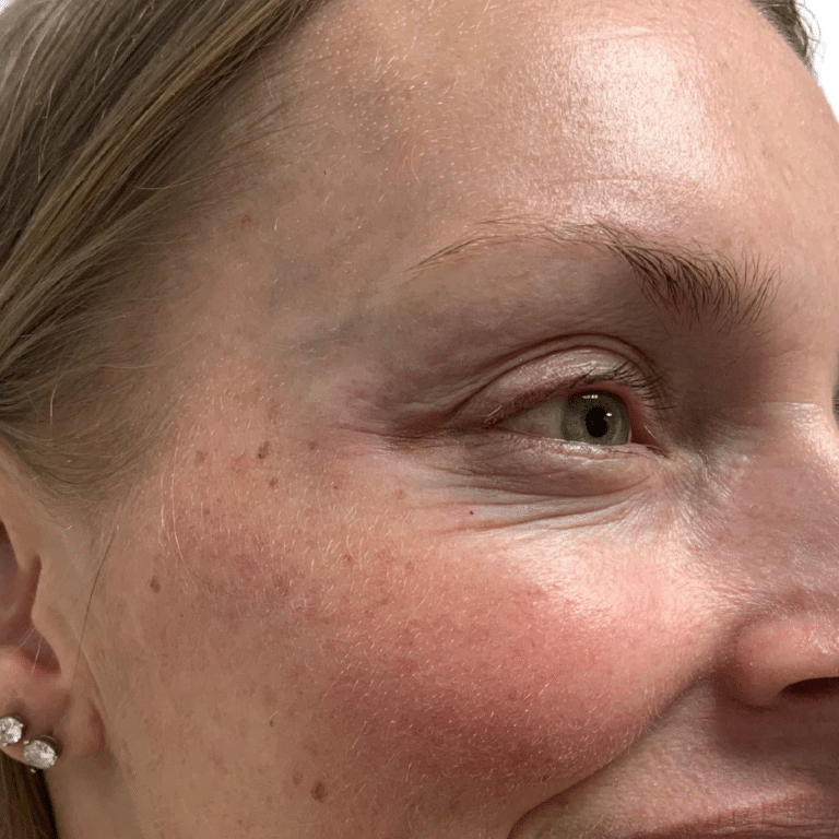 After Image: Botox/Dysport - front
