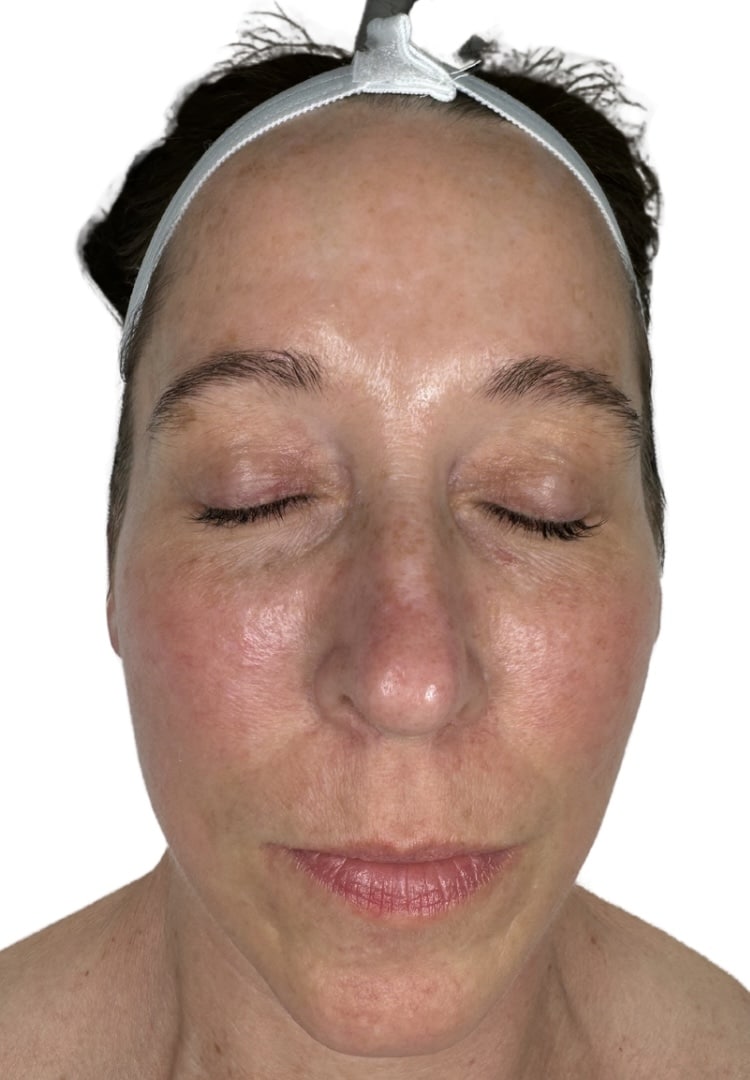 After Image: Microneedling - front