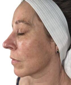 Before Image: Microneedling