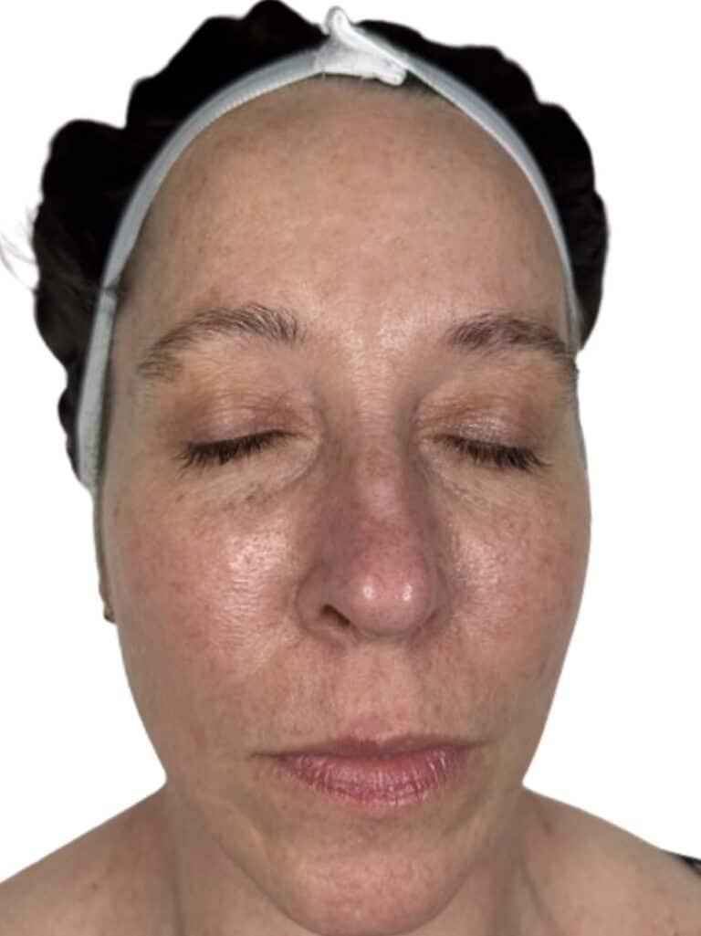 Before Image: Microneedling - front