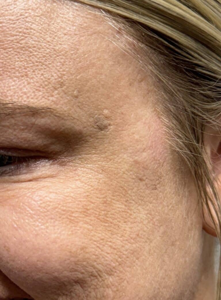 After Image: Botox/Dysport - front