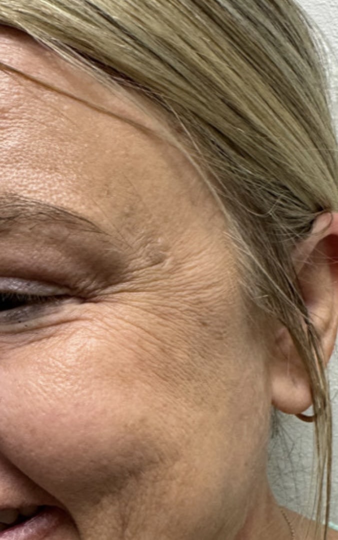 Before Image: Botox/Dysport - front