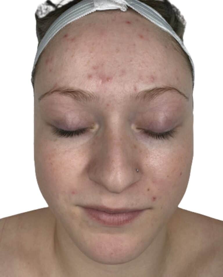 Before Image: Acne Chemical Peel - front