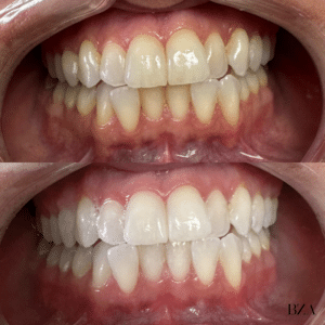 Before Image: Teeth Whitening