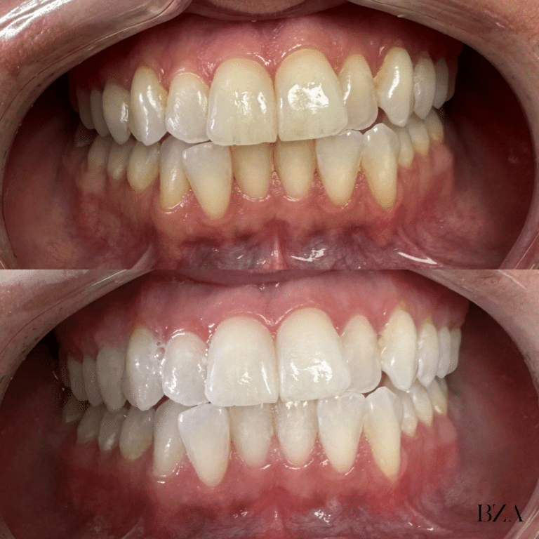 Before Image: Teeth Whitening - front