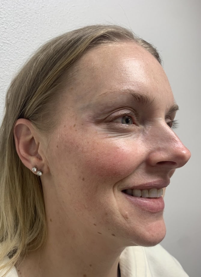After Image: Botox/Dysport - front
