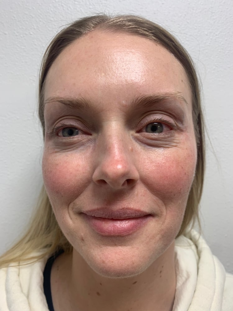After Image: Botox/Dysport - front