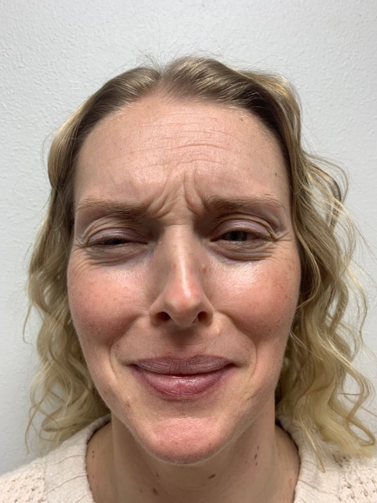 Before Image: Botox/Dysport - front