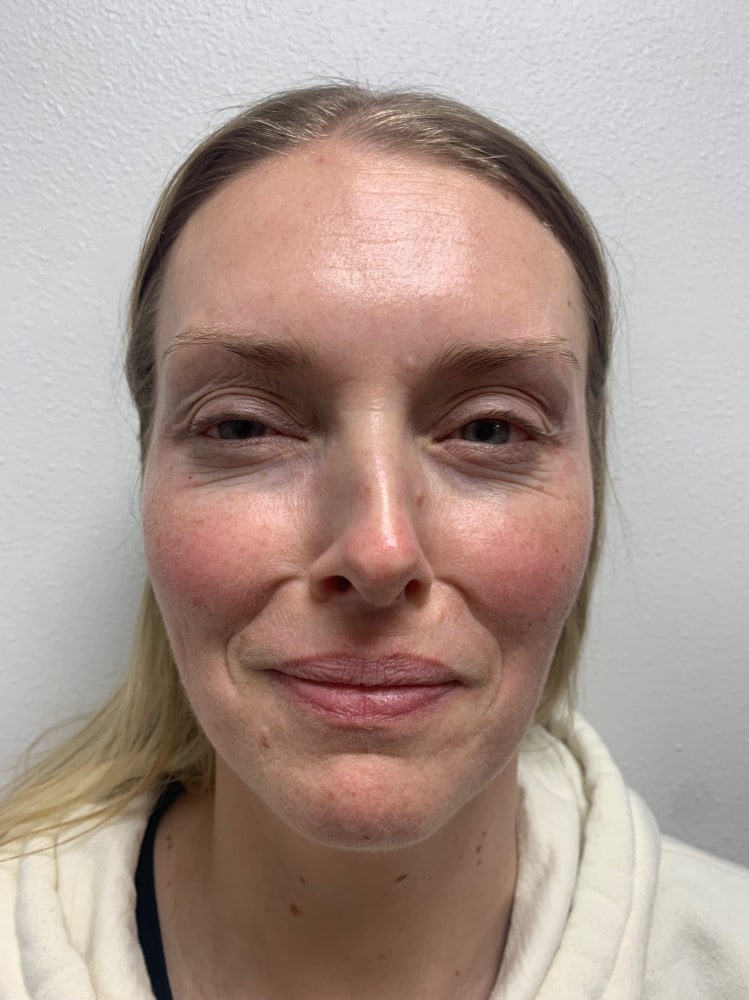 After Image: Botox/Dysport - front