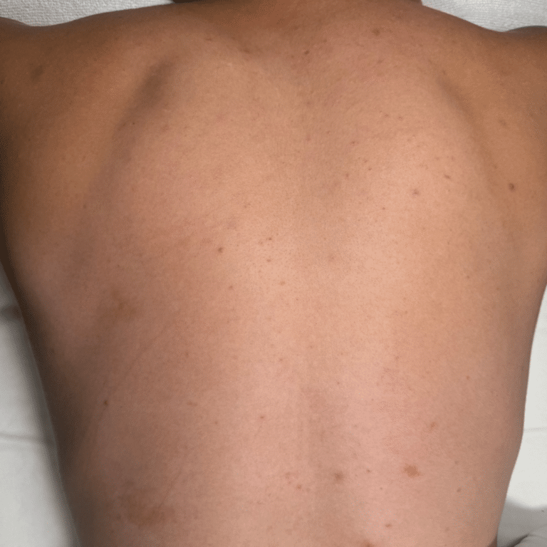 After Image: Back Chemical Peel - front