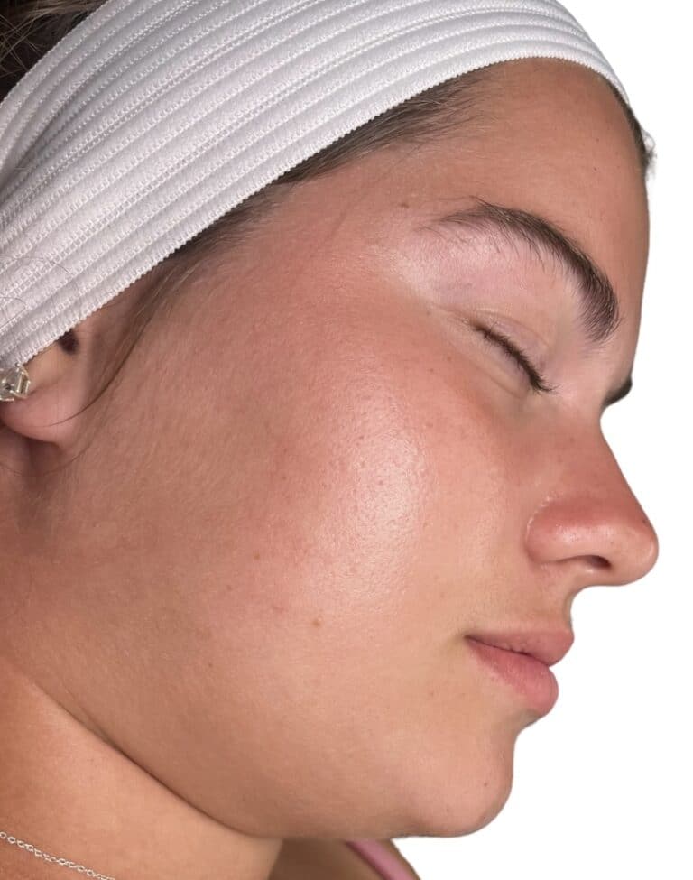 After Image: Acne Chemical Peel - front