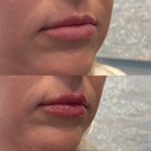 After Image: Lip Filler