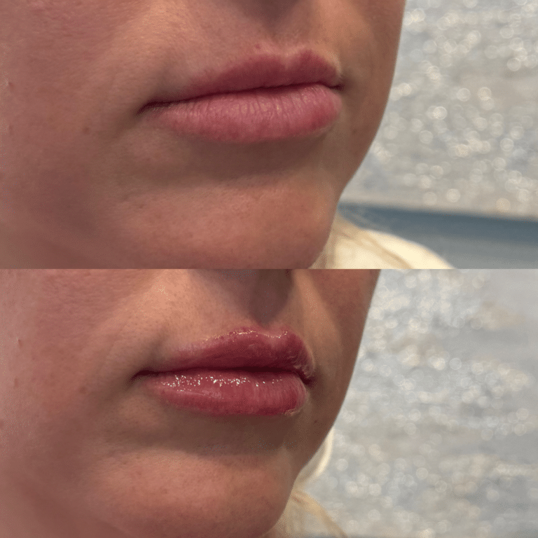 After Image: Lip Filler - front