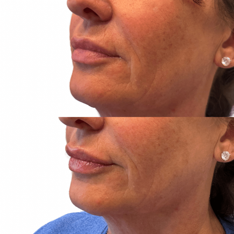 After Image: Lip Filler - front