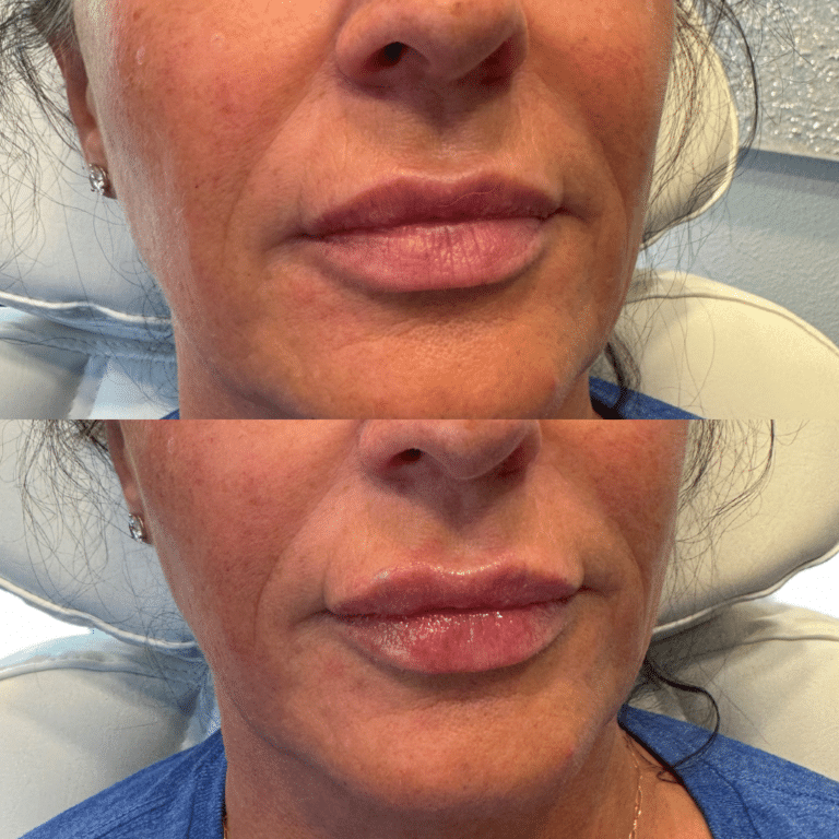 Before Image: Lip Filler - front