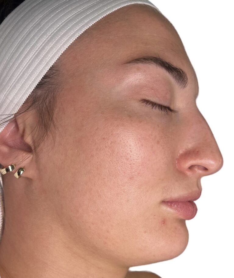 After Image: Acne Chemical Peel - front