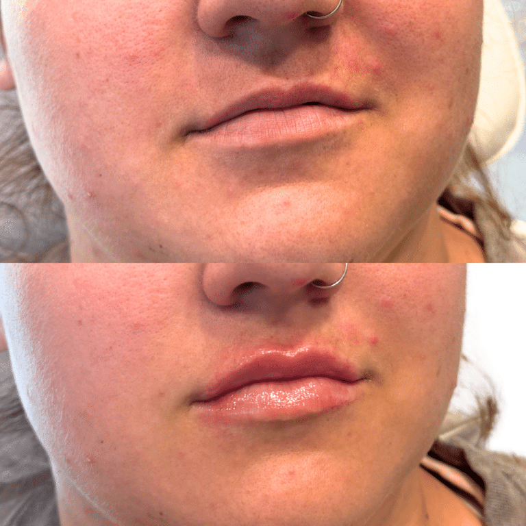 Before Image: Lip Filler - front