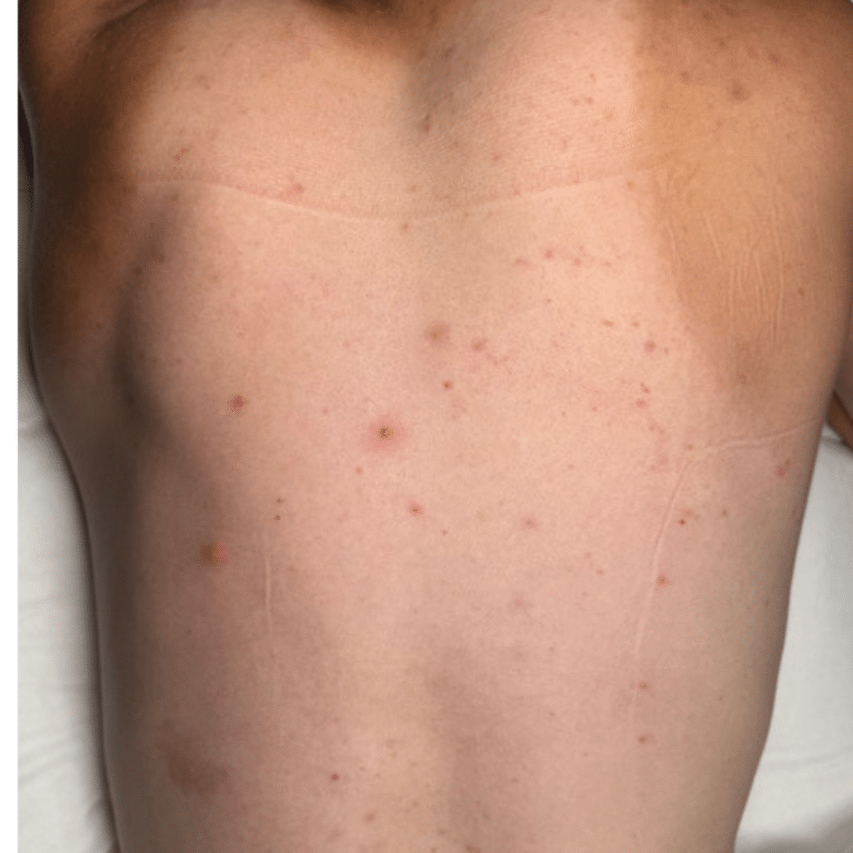Before Image: Back Chemical Peel - front