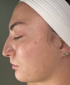 After Image: Acne Chemical Peel