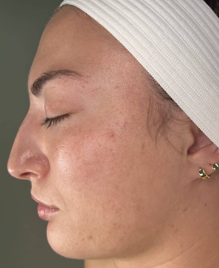 After Image: Acne Chemical Peel - front