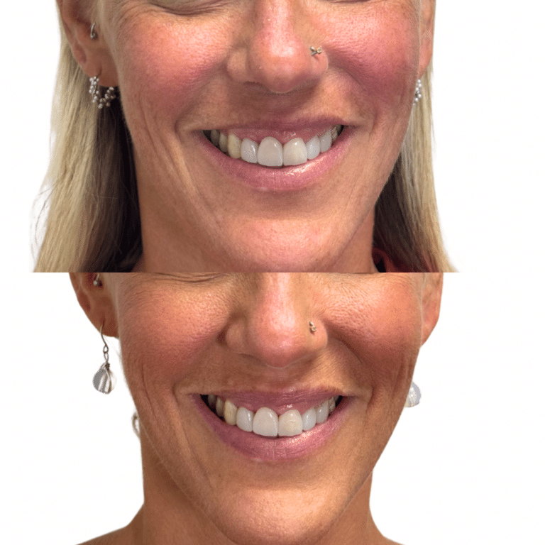 After Image: Lip Flip - front