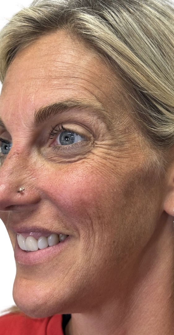 Before Image: Botox/Dysport - front