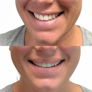 Before Image: Lip Flip