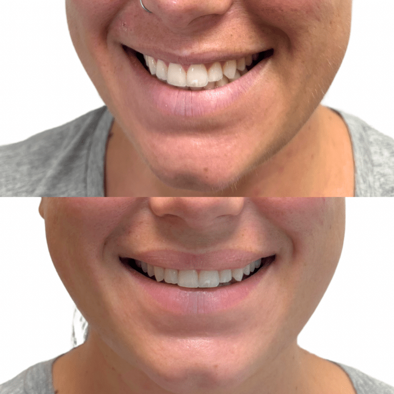 Before Image: Lip Flip - front