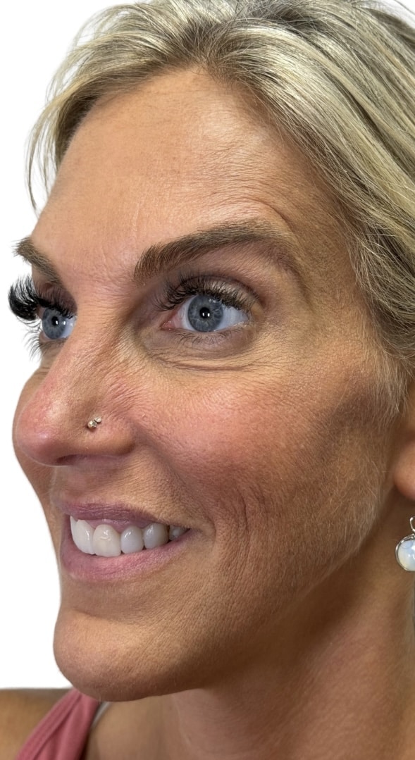 After Image: Botox/Dysport - front