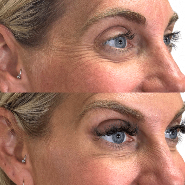 Before Image: Botox/Dysport - front