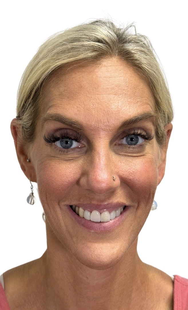 After Image: Botox/Dysport - front
