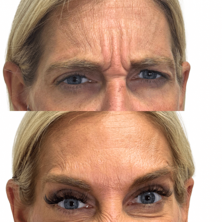 After Image: Botox/Dysport - front