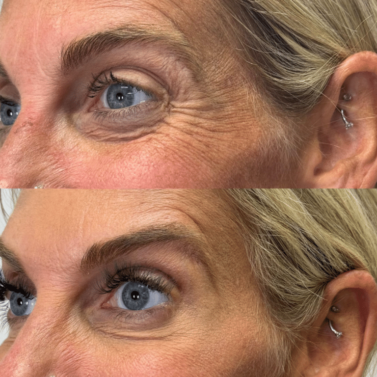 After Image: Botox/Dysport - front
