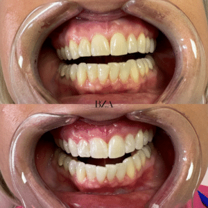 After Image: Teeth Whitening