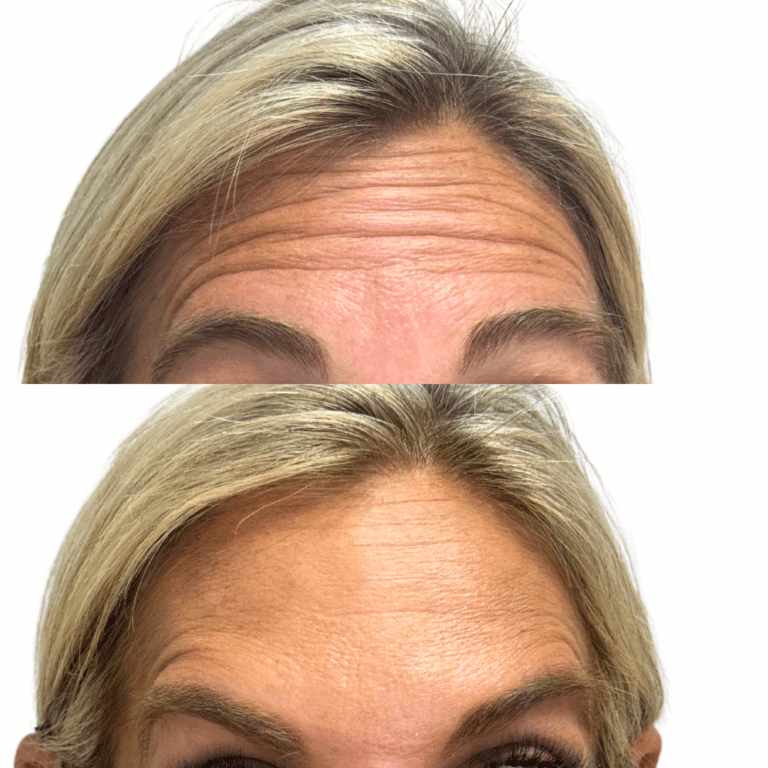 Before Image: Botox/Dysport - front