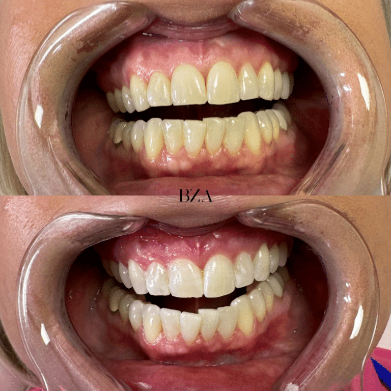 After Image: Teeth Whitening - front