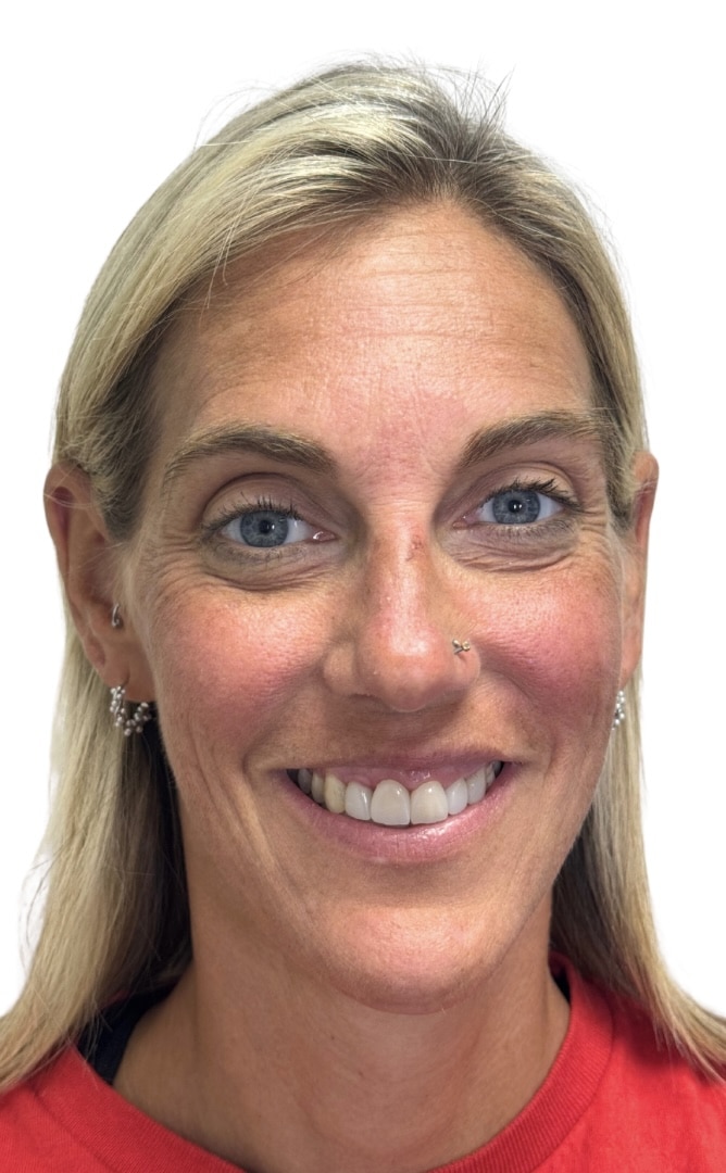 Before Image: Botox/Dysport - front