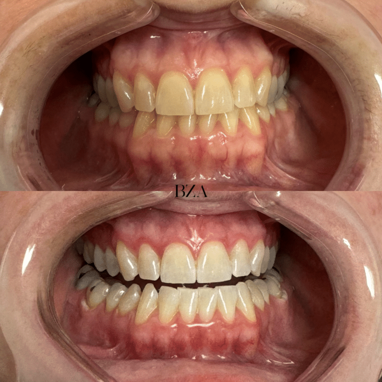 Before Image: Teeth Whitening - front