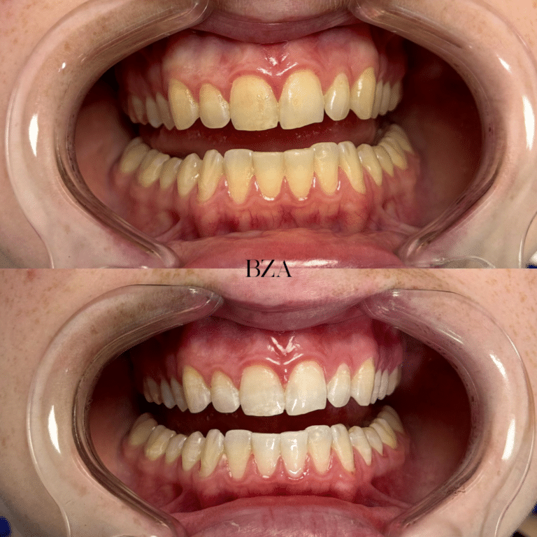 Before Image: Teeth Whitening - front