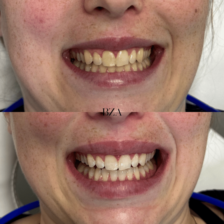 After Image: Teeth Whitening - front